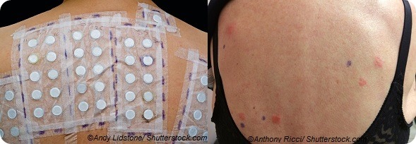 patch test